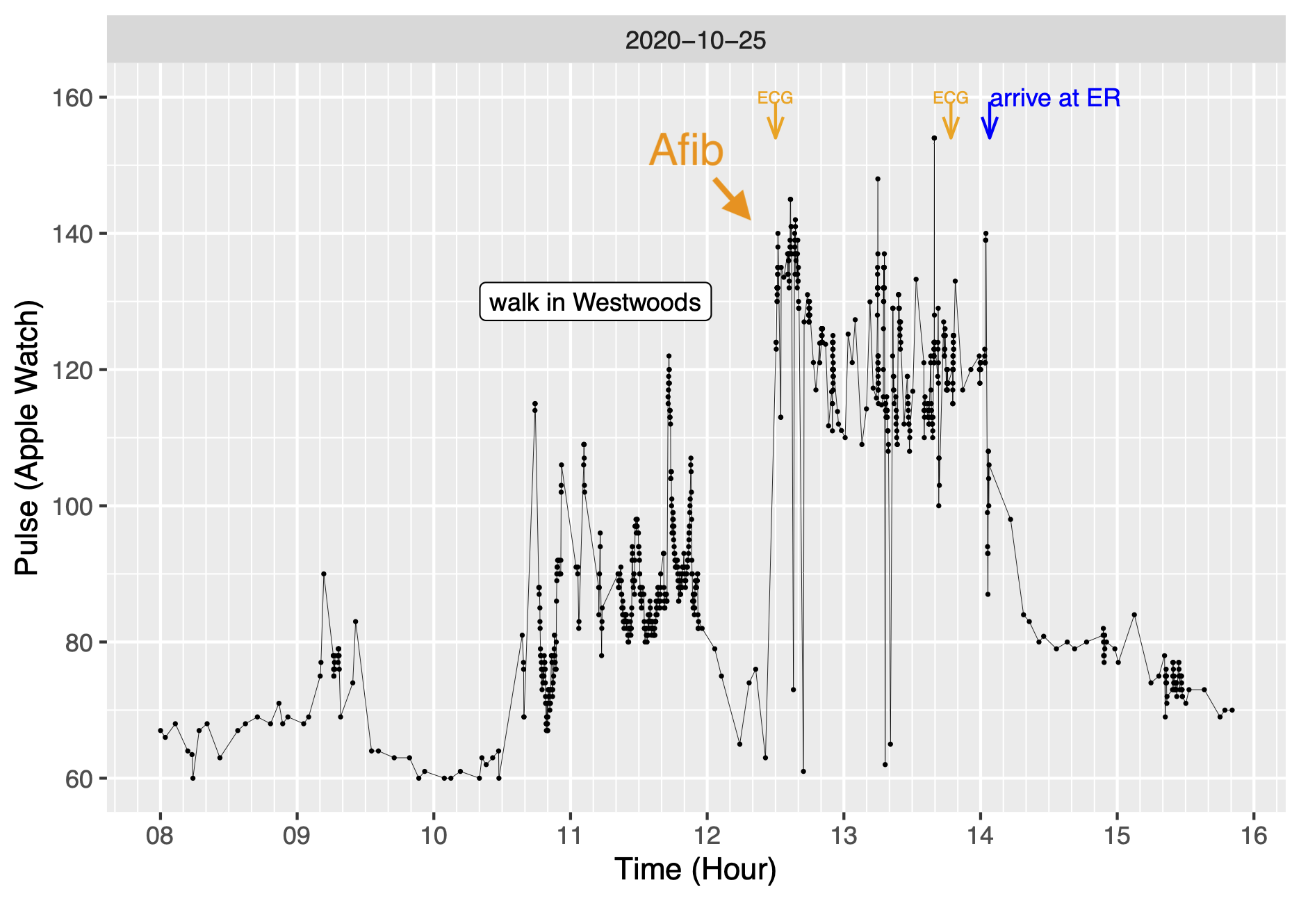 Pulse on x-axis during showing elevated heart rate during period of atrial fibrillation and marking when Watch electrocardiogram taken