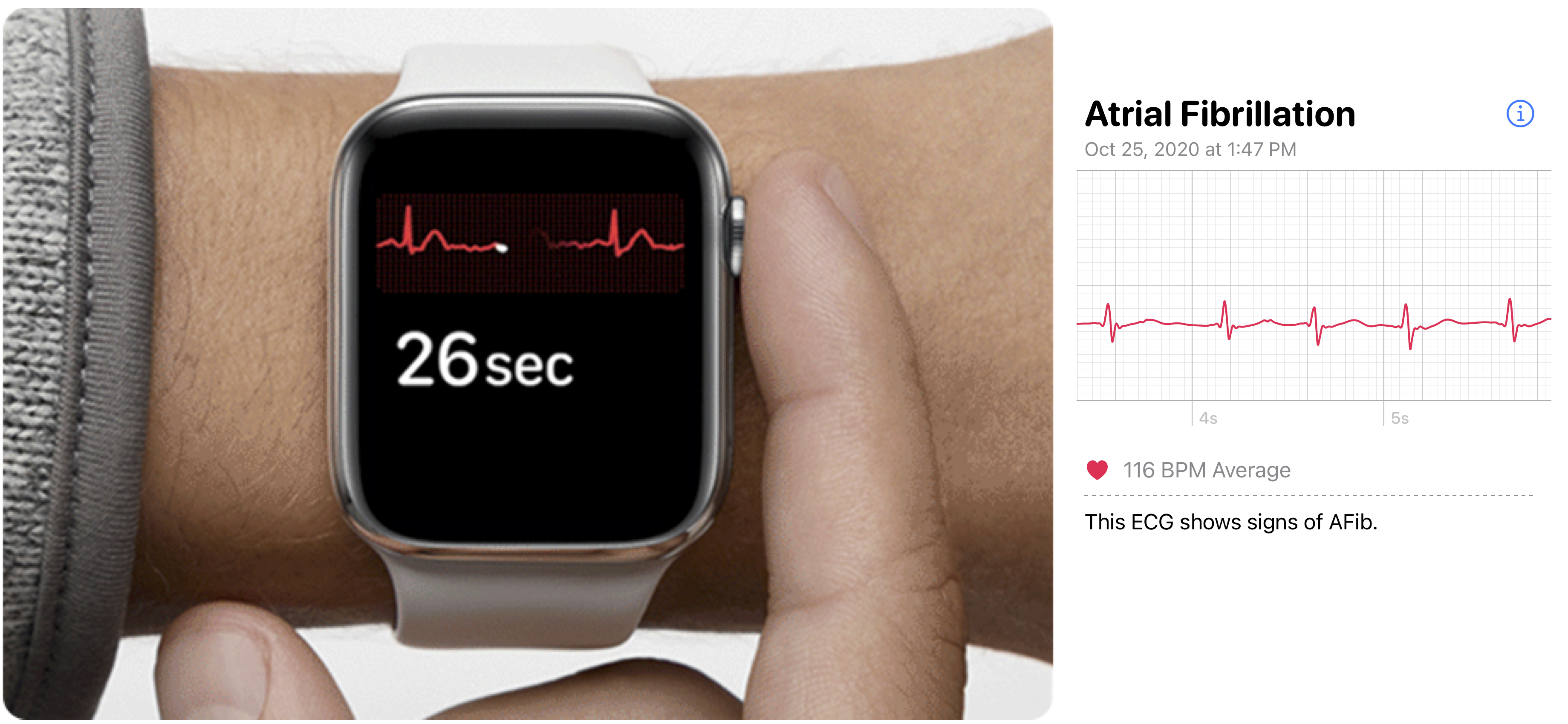 Picture on the left shows how to do an ECG with the Watch and on the right shows a ECG flagged as atrial fibrillation